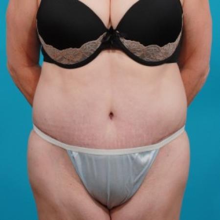 After image 1 Case #84091 - Abdominoplasty