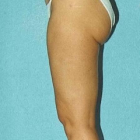 After image 2 Case #79171 - Liposuction