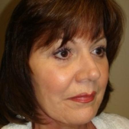 After image 3 Case #79621 - Blepharoplasty