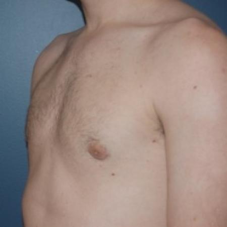 After image 2 Case #81231 - Bilateral gynecomastia