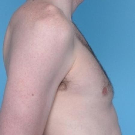 After image 2 Case #79266 - Male Breast Reduction