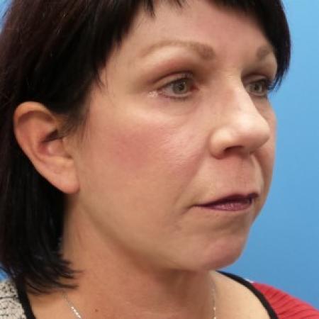 After image 2 Case #86566 - Facelift/Lower Blepharoplasty/Browlift/Laser Resurfacing to Full Face     4 months post-op