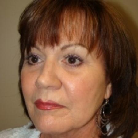 After image 2 Case #79616 - Facelift