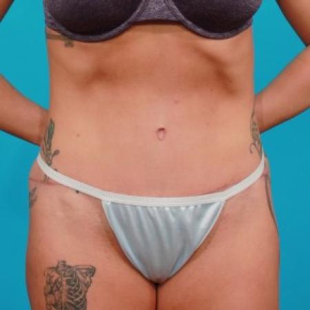 After image 1 Case #83936 - Athletic Tummy Tuck