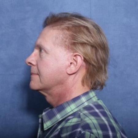 After image 2 Case #83681 - 63 Year Old Male