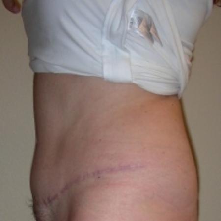 After image 3 Case #79766 - Tummy Tuck & Lipo of Love Handles