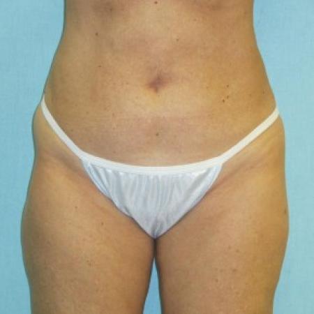 After image 1 Case #82731 - Liposculpture - hips and thighs