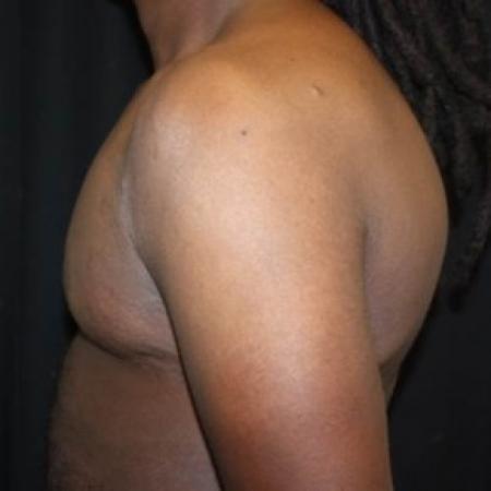 After image 3 Case #83056 - 22 year old Gynecomastia