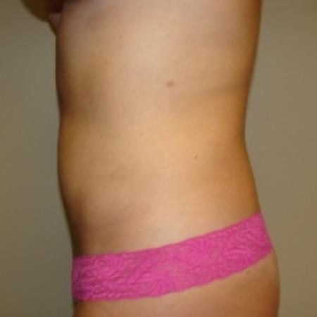 After image 5 Case #79946 - Liposuction