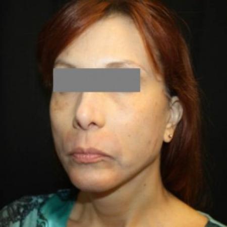 After image 2 Case #84386 - Facelift/Facial Rejuvenation - 54 year old female
