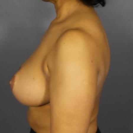 After image 2 Case #83441 - Breast Reduction