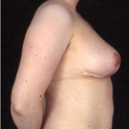 After image 3 Case #81481 - Breast Augmentation