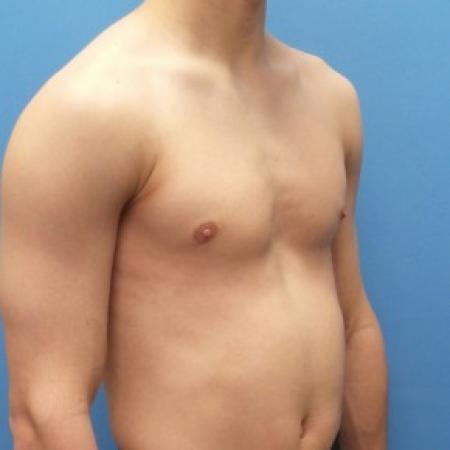After image 2 Case #87306 - 17-year old  -  Excisional Gynecomastia right breast