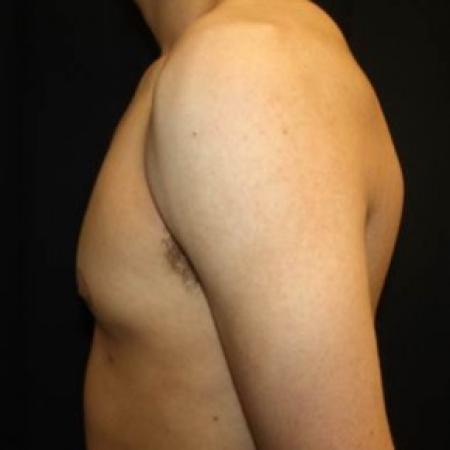 After image 3 Case #85276 - Gynecomastia - 17 year old male 