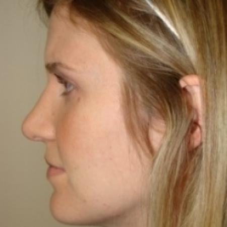 After image 5 Case #79551 - Rhinoplasty