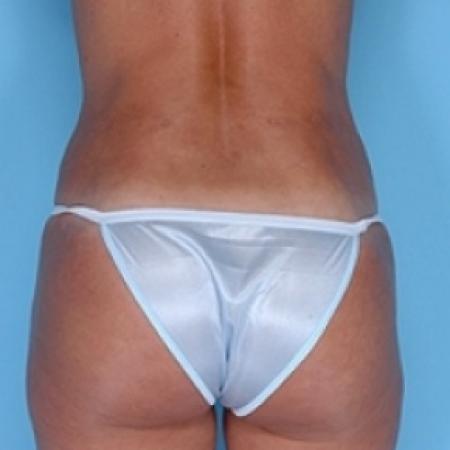 After image 4 Case #79241 - Liposuction