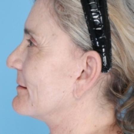 After image 2 Case #79691 - Facelift 