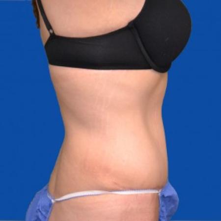 After image 2 Case #87856 - Tummy Tuck