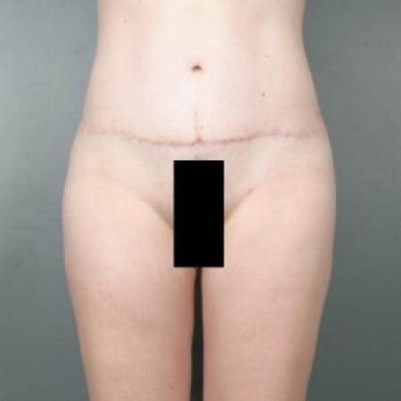 After image 1 Case #83616 - Liposuction to Thighs and Hips