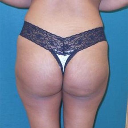 After image 2 Case #84911 - Buttock Augmenation with implants and liposuction of the abdomen