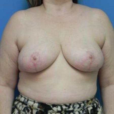 After image 1 Case #80961 - Bilateral breast reduction 