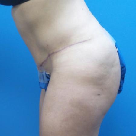 After image 3 Case #88171 - 41 year old  -  Abdominoplasty  -  3 months post-op
