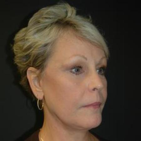 After image 2 Case #80871 - Facelift, Fat Transfer, Lower Blepharoplasty