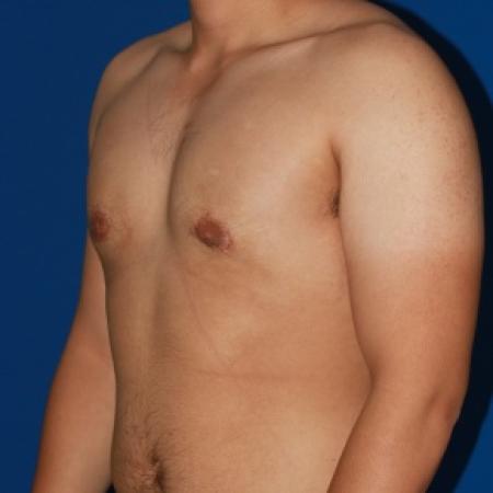 After image 2 Case #79991 - Gynecomastia male breast reduction