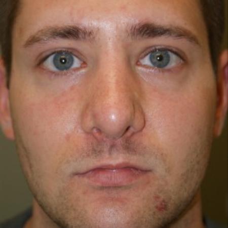 After image 1 Case #81896 - Open Structure Septorhinoplasty and Sub-Mucous Resection