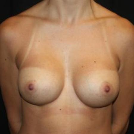 After image 1 Case #85841 - Breast Augmentation - 32 year old female