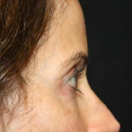 After image 3 Case #84886 - Upper LidBlepharoplasty & Brow Lift - 50 year old female