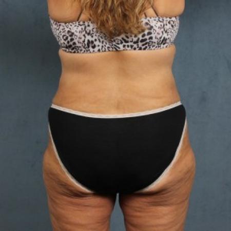 After image 4 Case #82551 - extended abdominoplasty (tummy tuck) after massive weight loss
