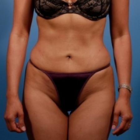 After image 1 Case #78641 - Liposuction: Abdomen & Flanks
