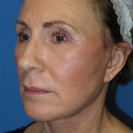 After image 2 Case #86576 - Facelift/Laser Resurfacing to Full Face     1 month post-op