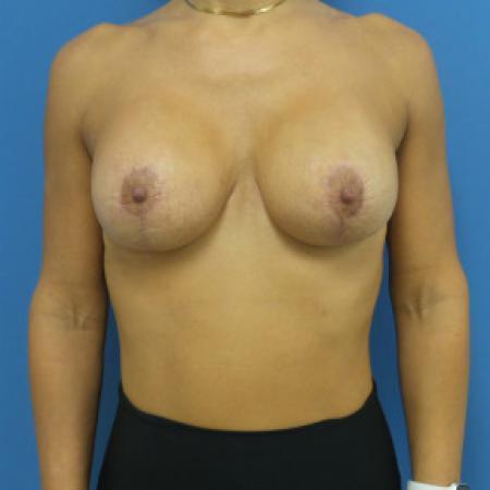 After Case #88461 - Bilateral Breast Augmentation with Lift