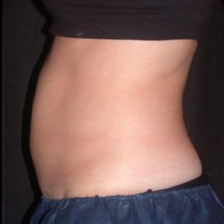After image 2 Case #81856 - CoolSculpting