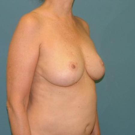 After image 2 Case #86721 - Breast Reduction inferior pedicle