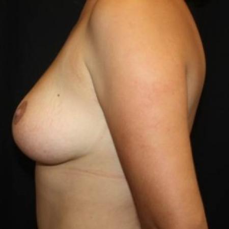 After image 3 Case #85166 - Breast Lift - 27 year old female