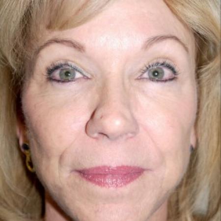 After image 1 Case #82441 - 56 year old with facial wrinkles, history of acne scarring