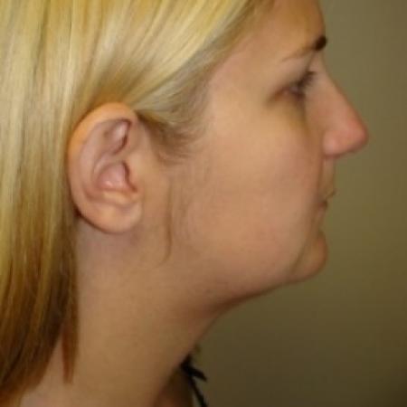 After image 2 Case #79611 - Submentoplasty