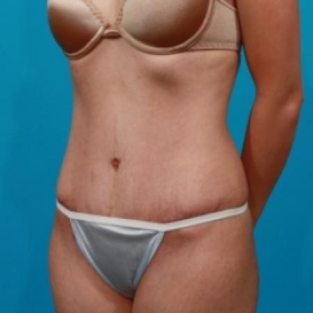 After image 2 Case #78881 - Tummy Tuck