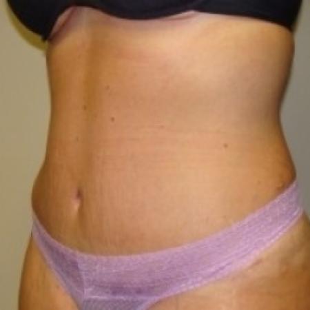 After image 2 Case #79471 - Tummy Tuck