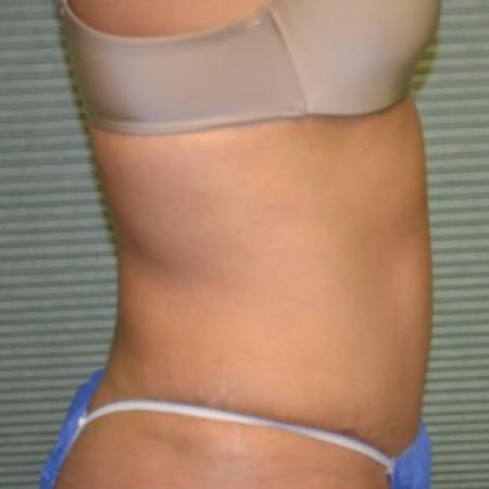 After image 2 Case #87886 - Tummy Tuck