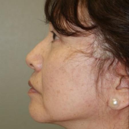 After image 3 Case #81911 - Facelift