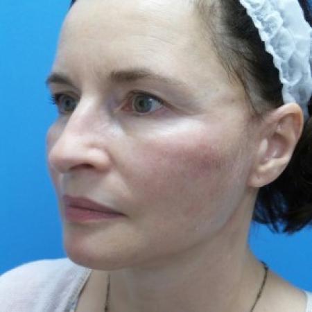 After image 2 Case #86976 - 57 year old  -  Facelift/Submental Liposuction  -  2 months post-op