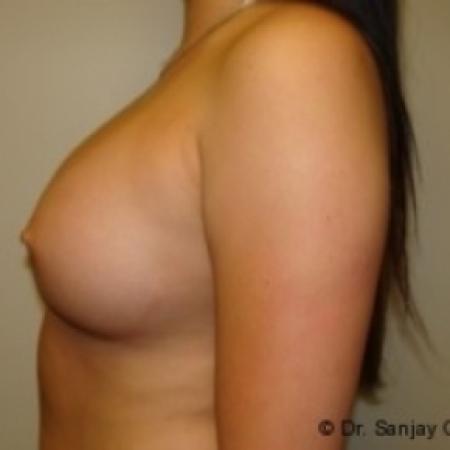 After image 3 Case #79021 - Breast Augmentation