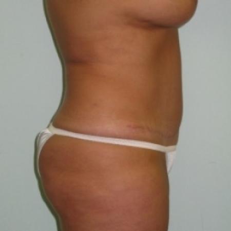 After image 2 Case #79916 - Tummy Tuck