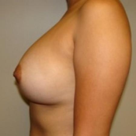 After image 3 Case #79421 - Breast Augmentation