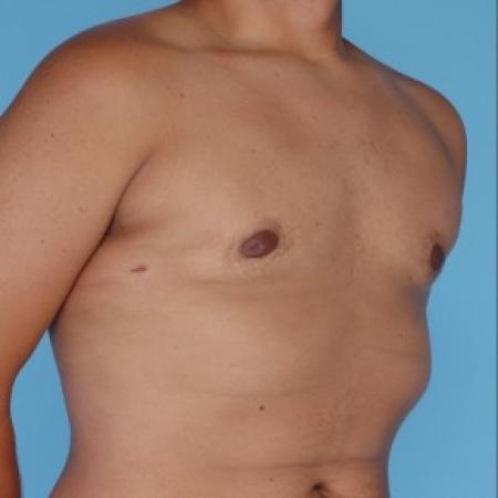 After image 2 Case #82251 - Liposuction