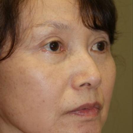 After image 2 Case #81911 - Facelift